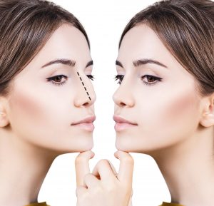 Rinoplastia ciudad real